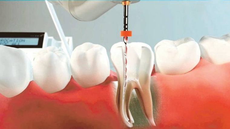 Implantes dentales, la tercera dentición que nos regala la ciencia