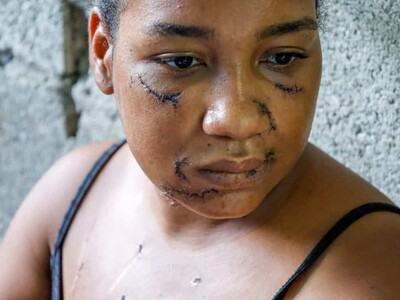 Recuperación de Nayely Altagracia Capellán tras ataque con 26 estocadas en La Vega